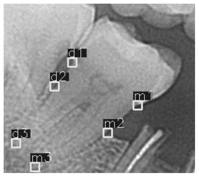 Method for identifying periodontitis absorption degree based on mesial and distal key points