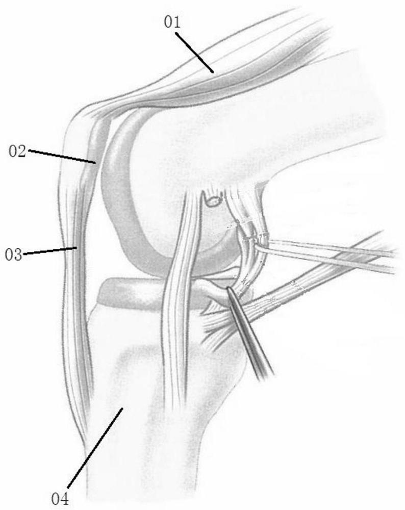 A fixation structure for tibial tuberosity fracture