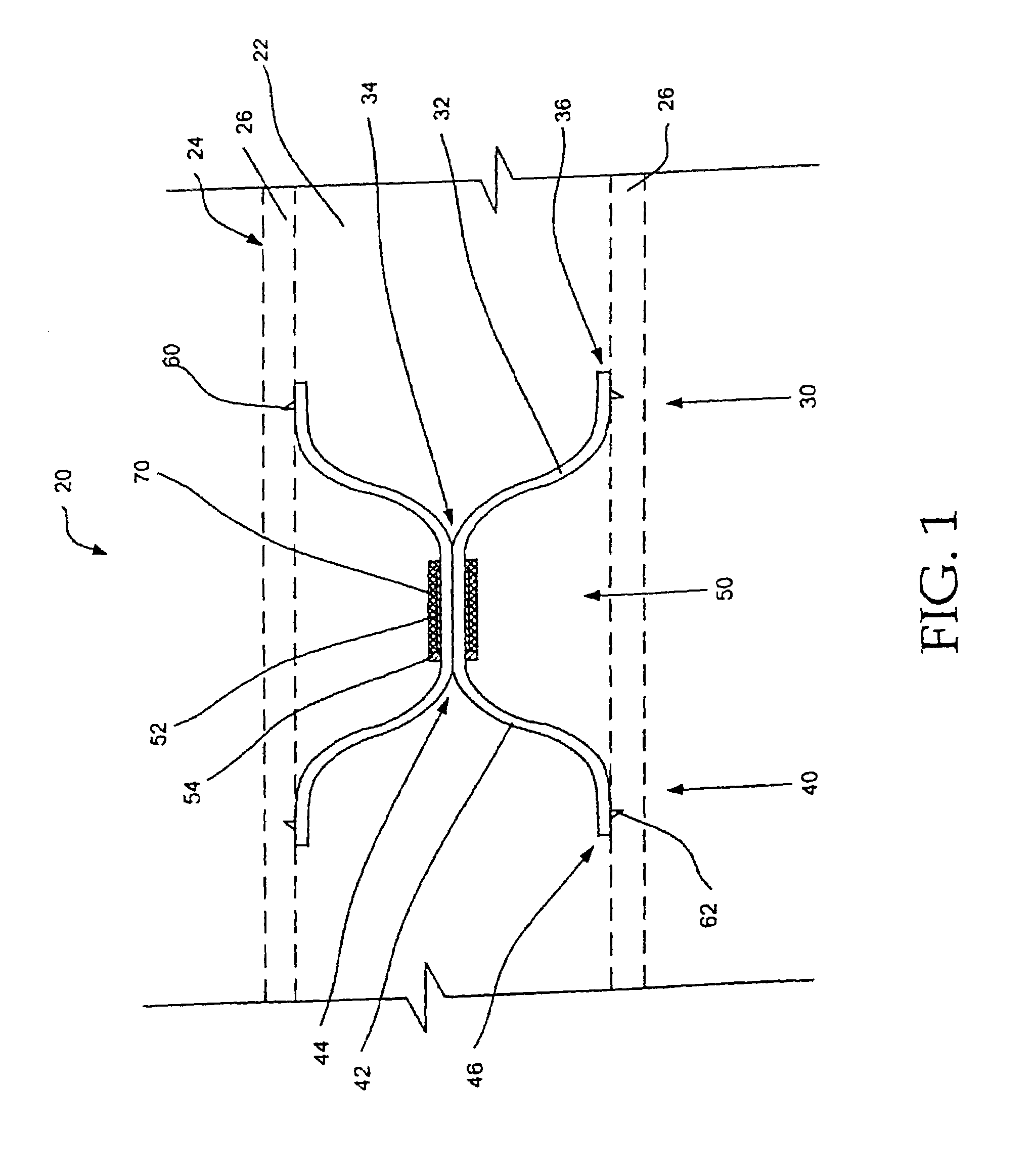 Intravascular filter retrieval device and method