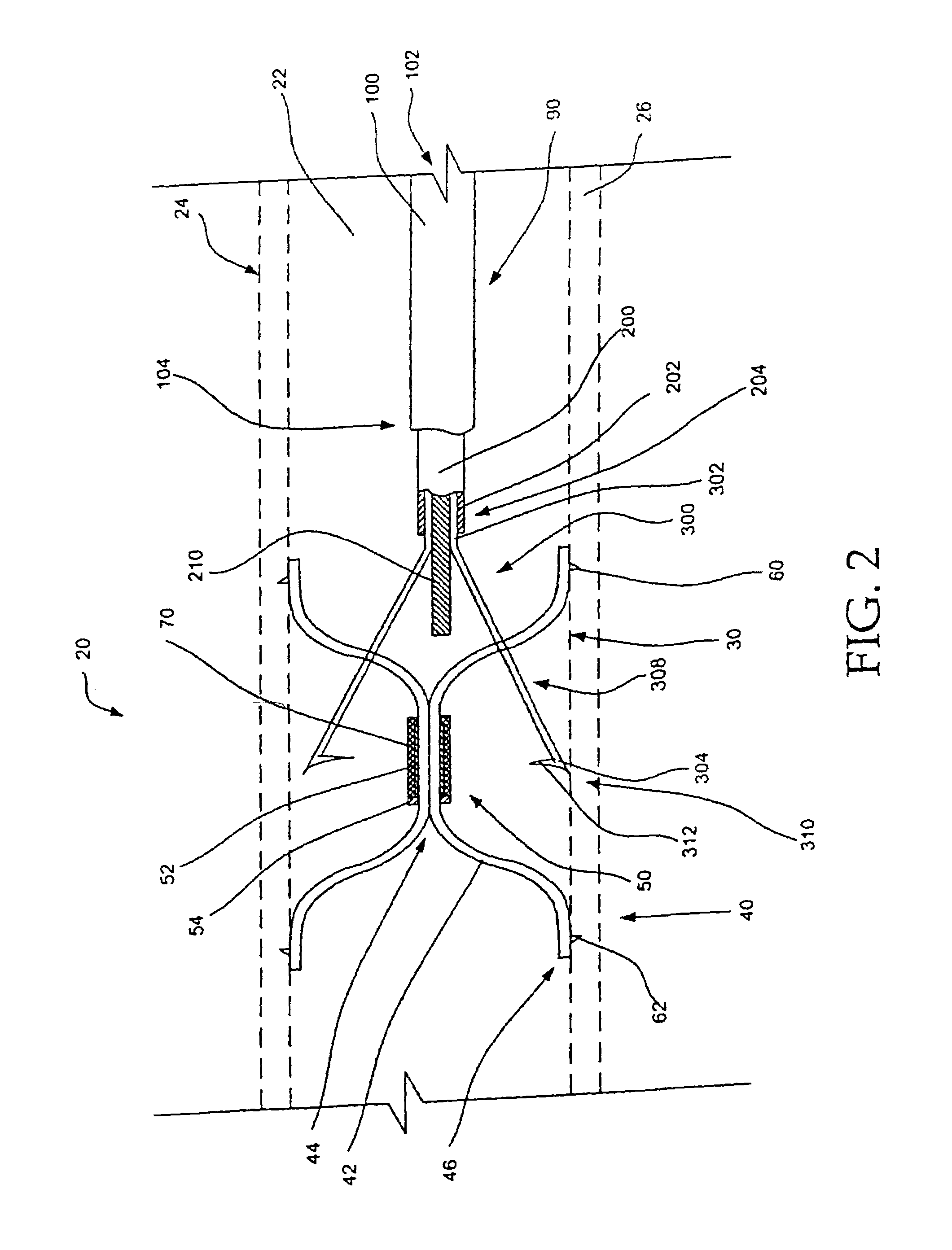 Intravascular filter retrieval device and method