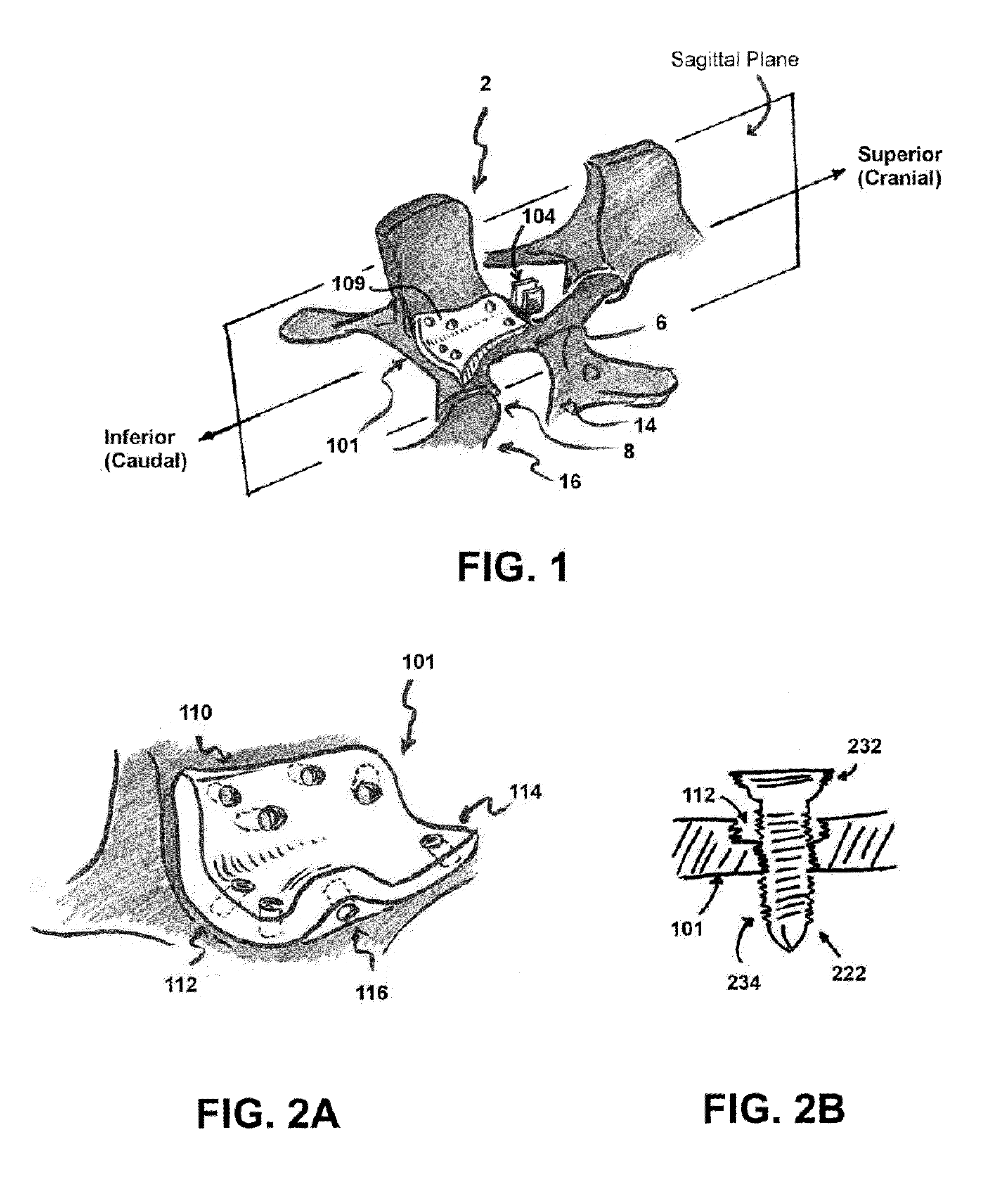 System and method to stablize a spinal column including a spinolaminar locking plate