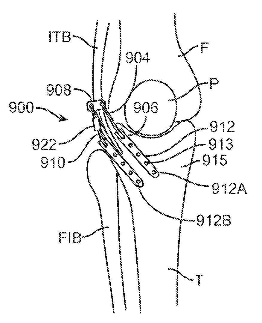 Method and Apparatus for Altering Biomechanics of the Articular Joints