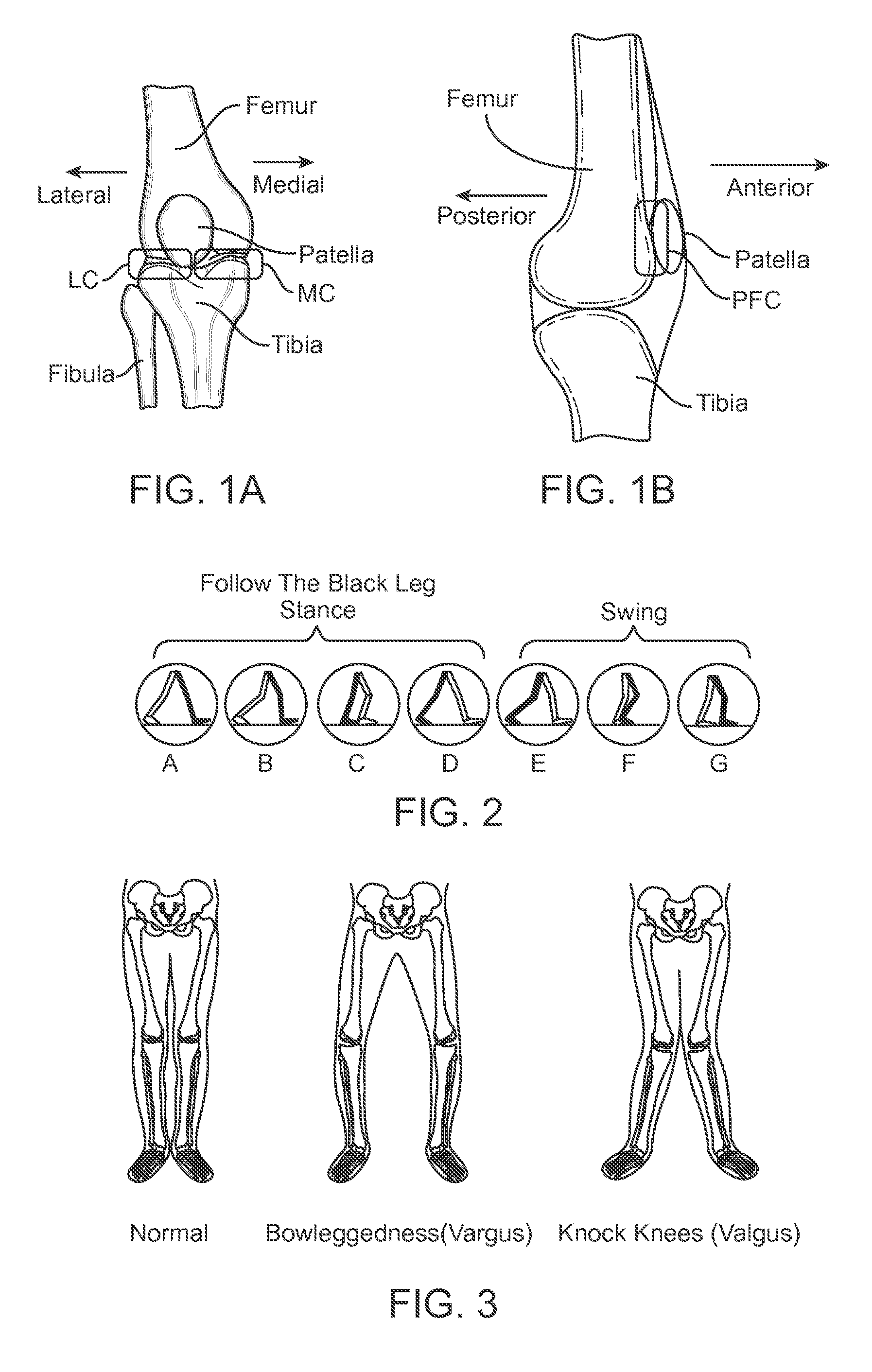 Method and Apparatus for Altering Biomechanics of the Articular Joints