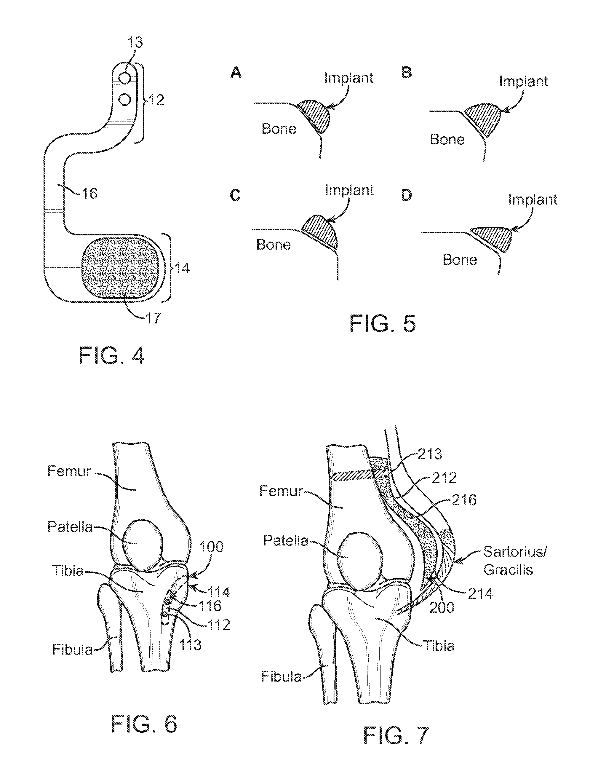 Method and Apparatus for Altering Biomechanics of the Articular Joints