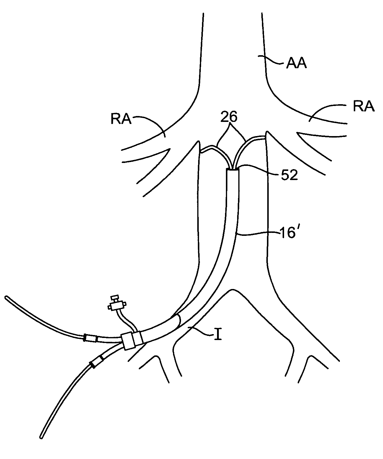 Systems and methods for bi-lateral guidewire cannulation of branched body lumens