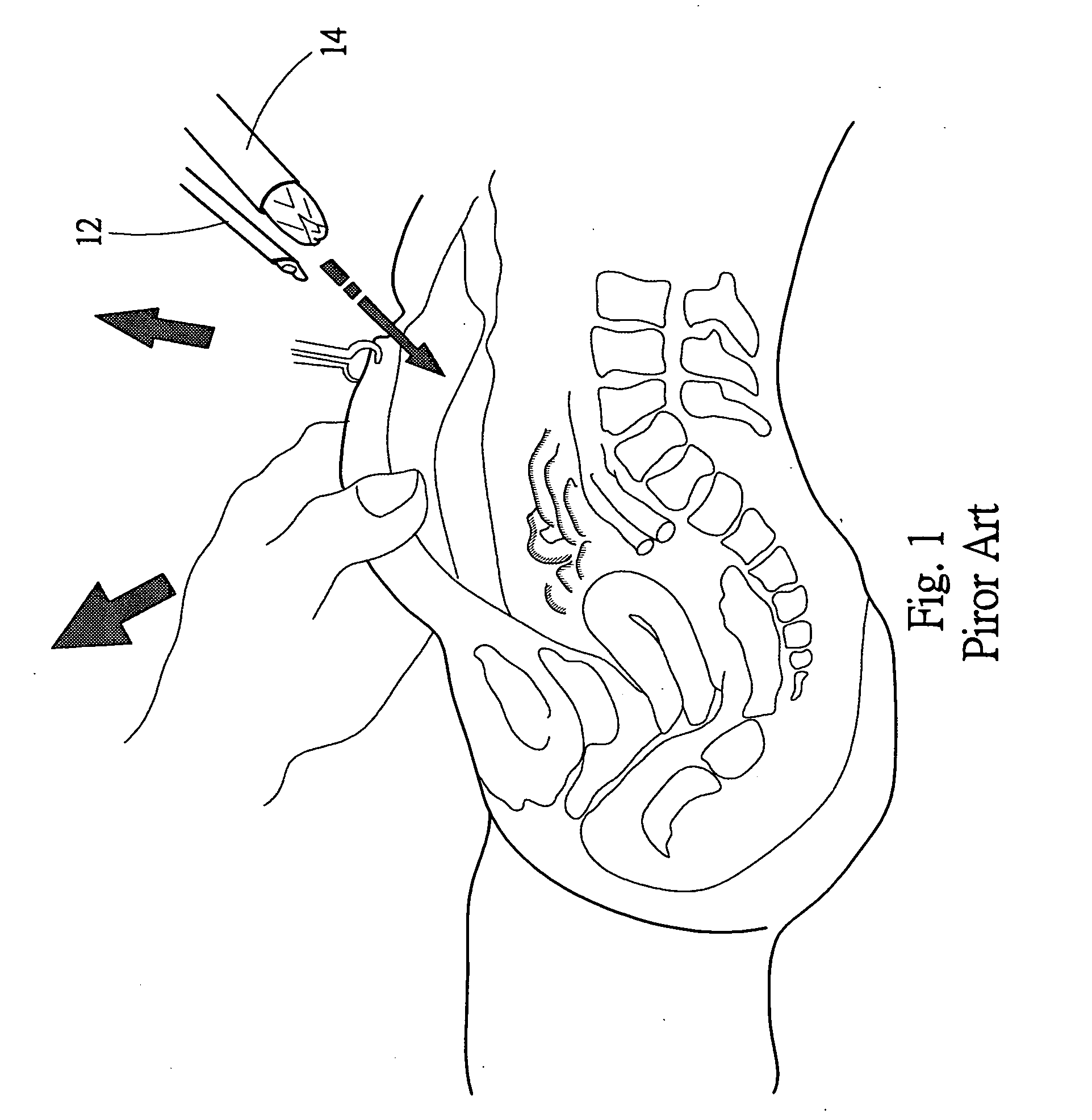 Safety trocar device