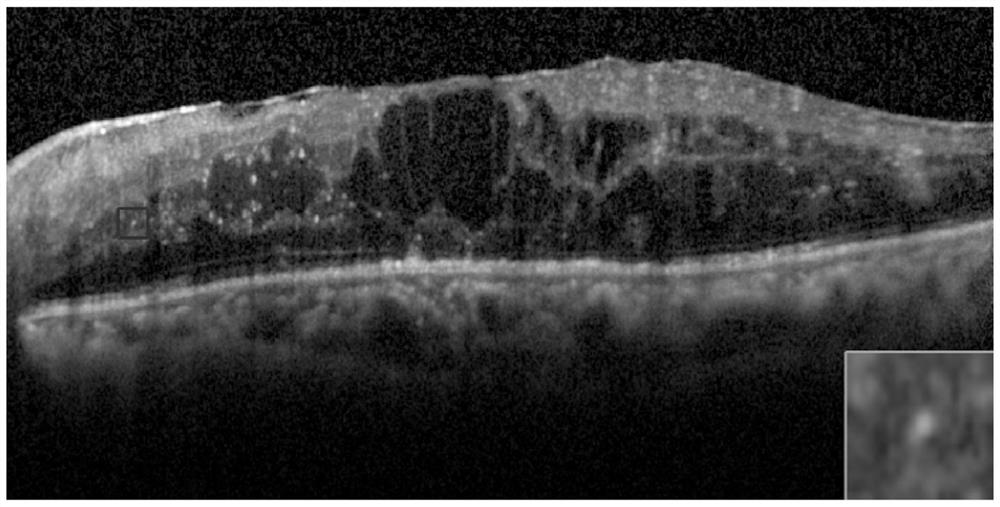 Segmentation method and realization system of ophthalmology sd-oct high reflection point based on image decomposition