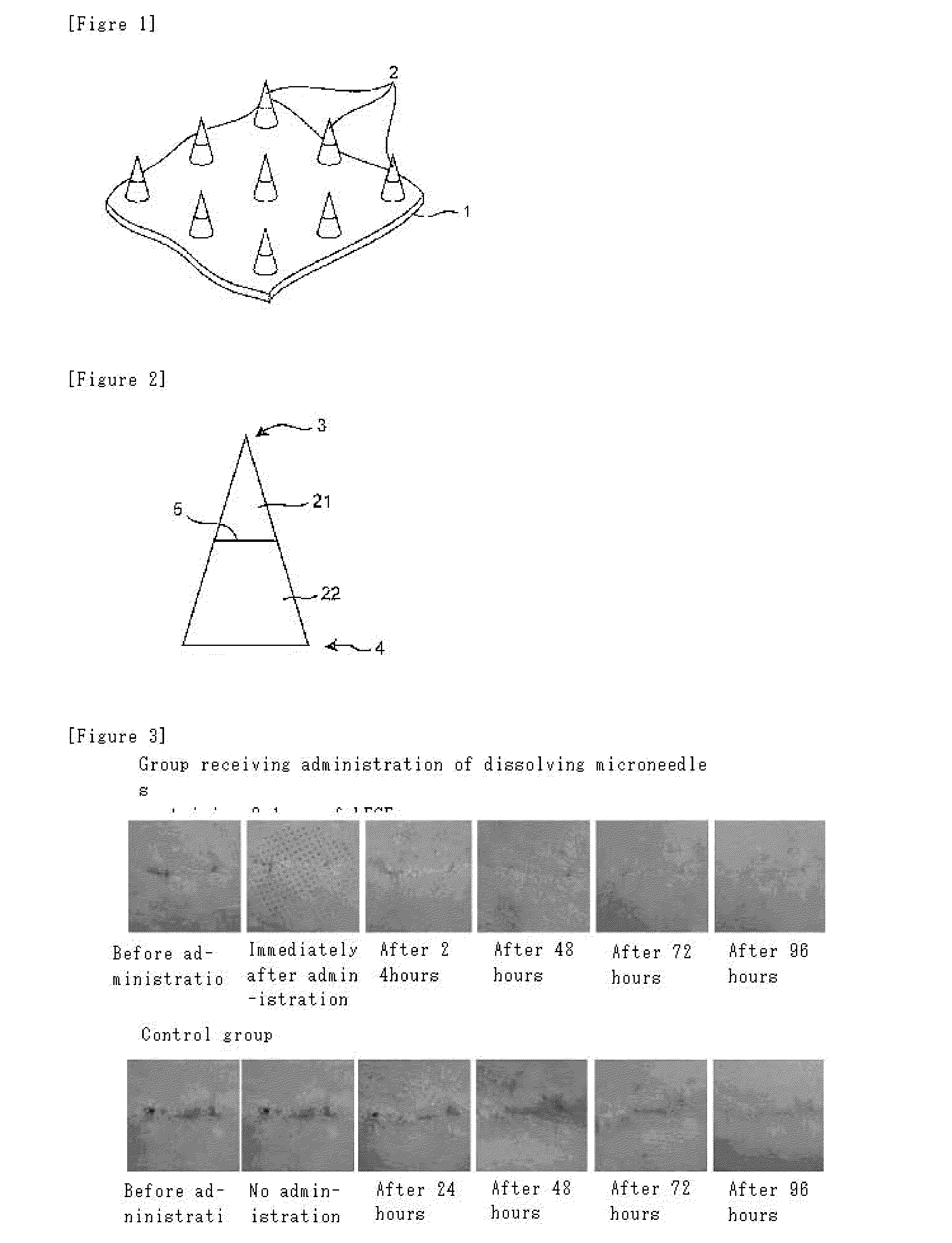 Microneedle assembly formulation for skin treatment