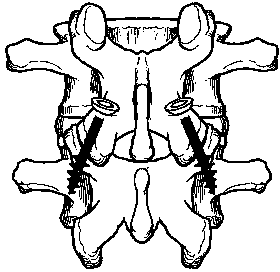 Combined type percutaneous zygopophysis pedicle screw internal fixation system