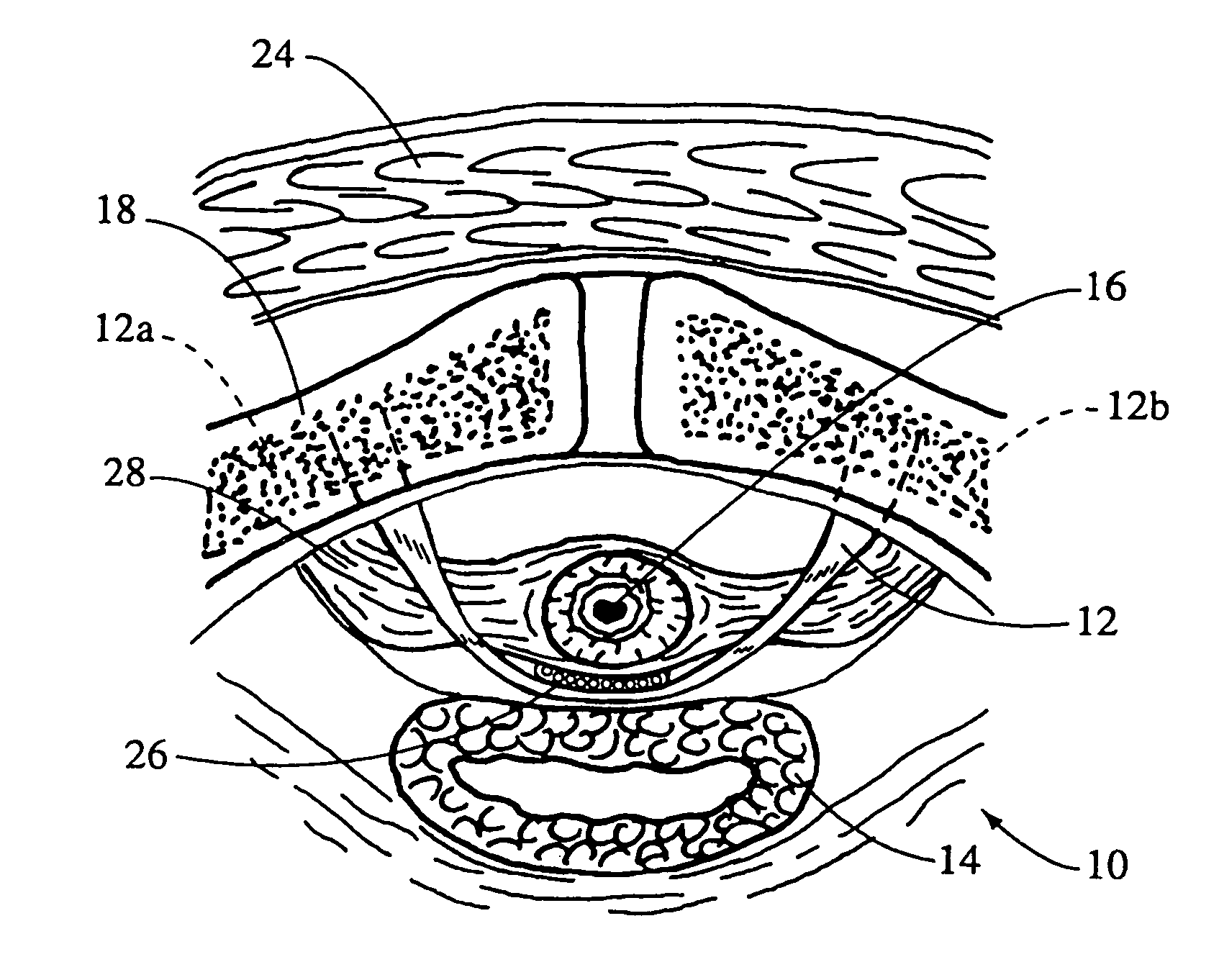 System and method for securing implants to soft tissue