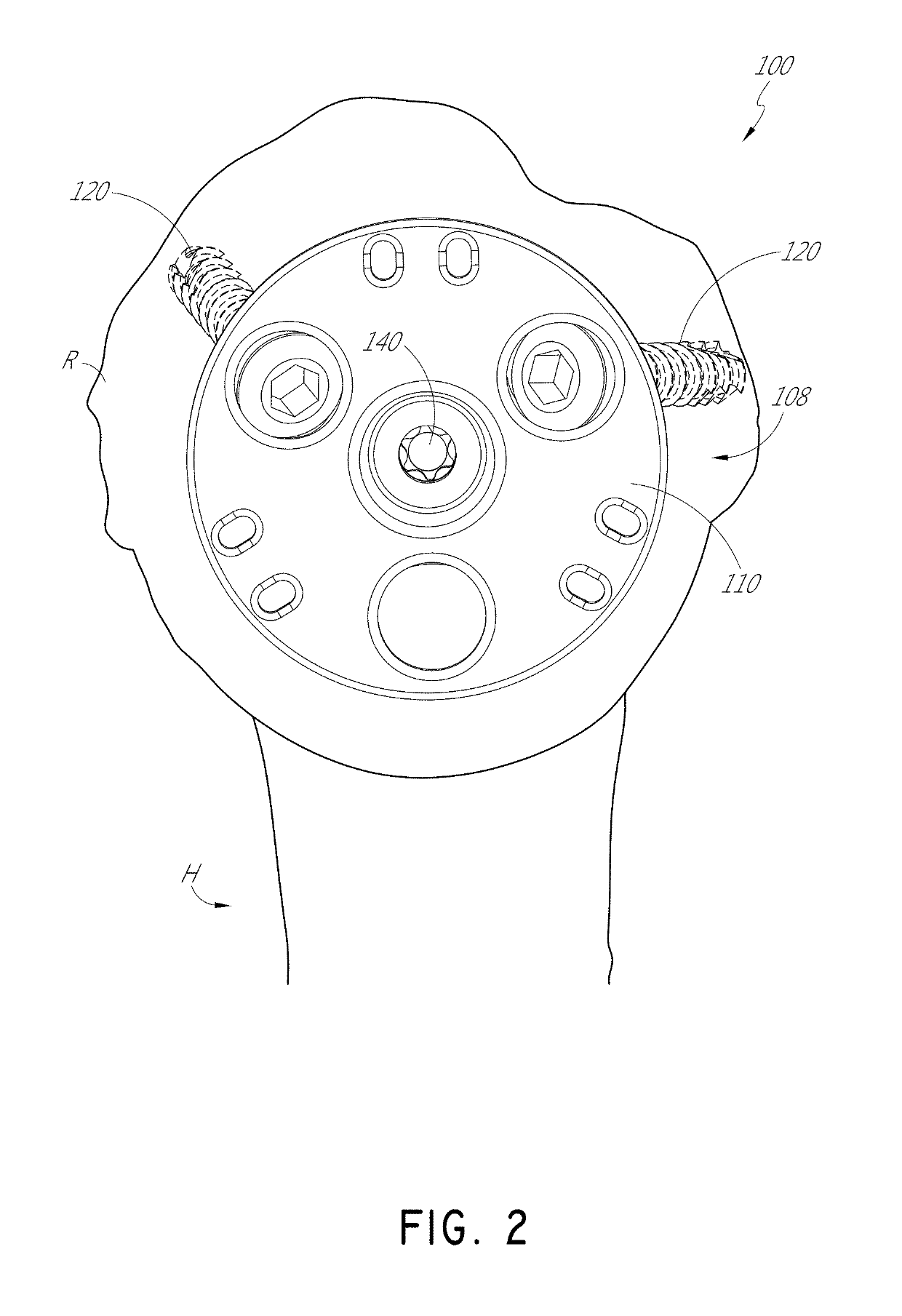 Stemless shoulder implant with fixation components