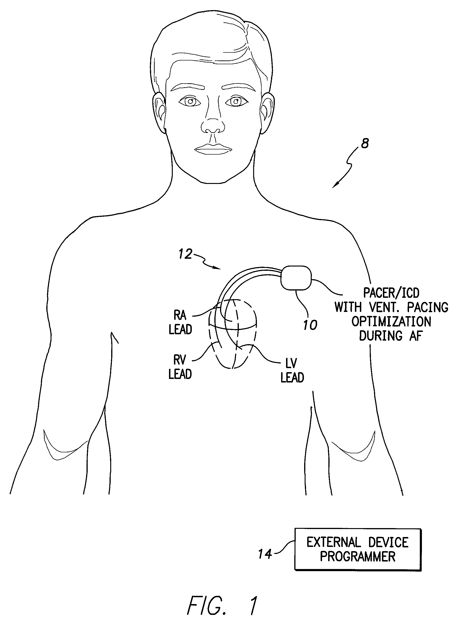 Systems and methods for optimizing ventricular pacing delays during atrial fibrillation