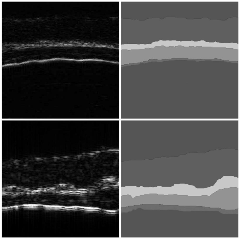 Ultrasonic endoscopic image intelligent segmentation and quantification method and system based on deep learning