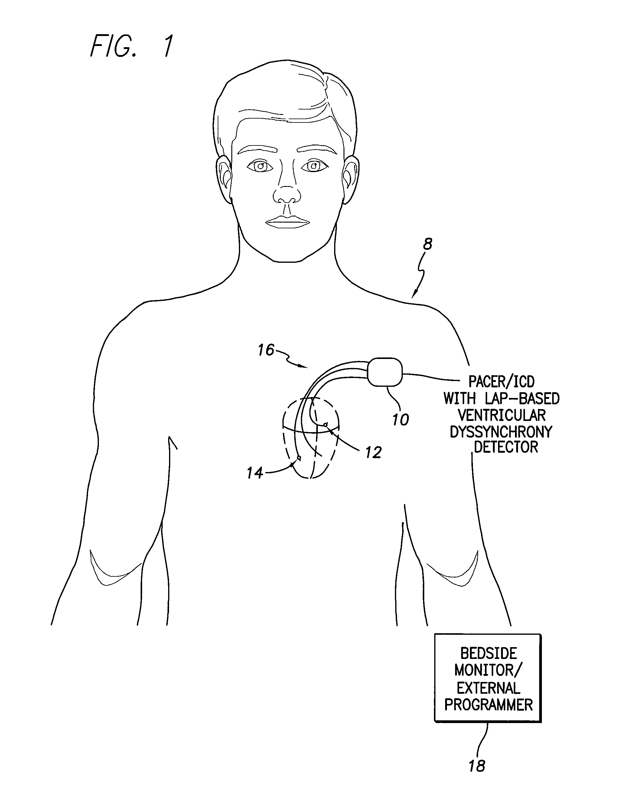 Systems and methods for evaluating ventricular dyssynchrony using atrial and ventricular pressure measurements obtained by an implantable medical device