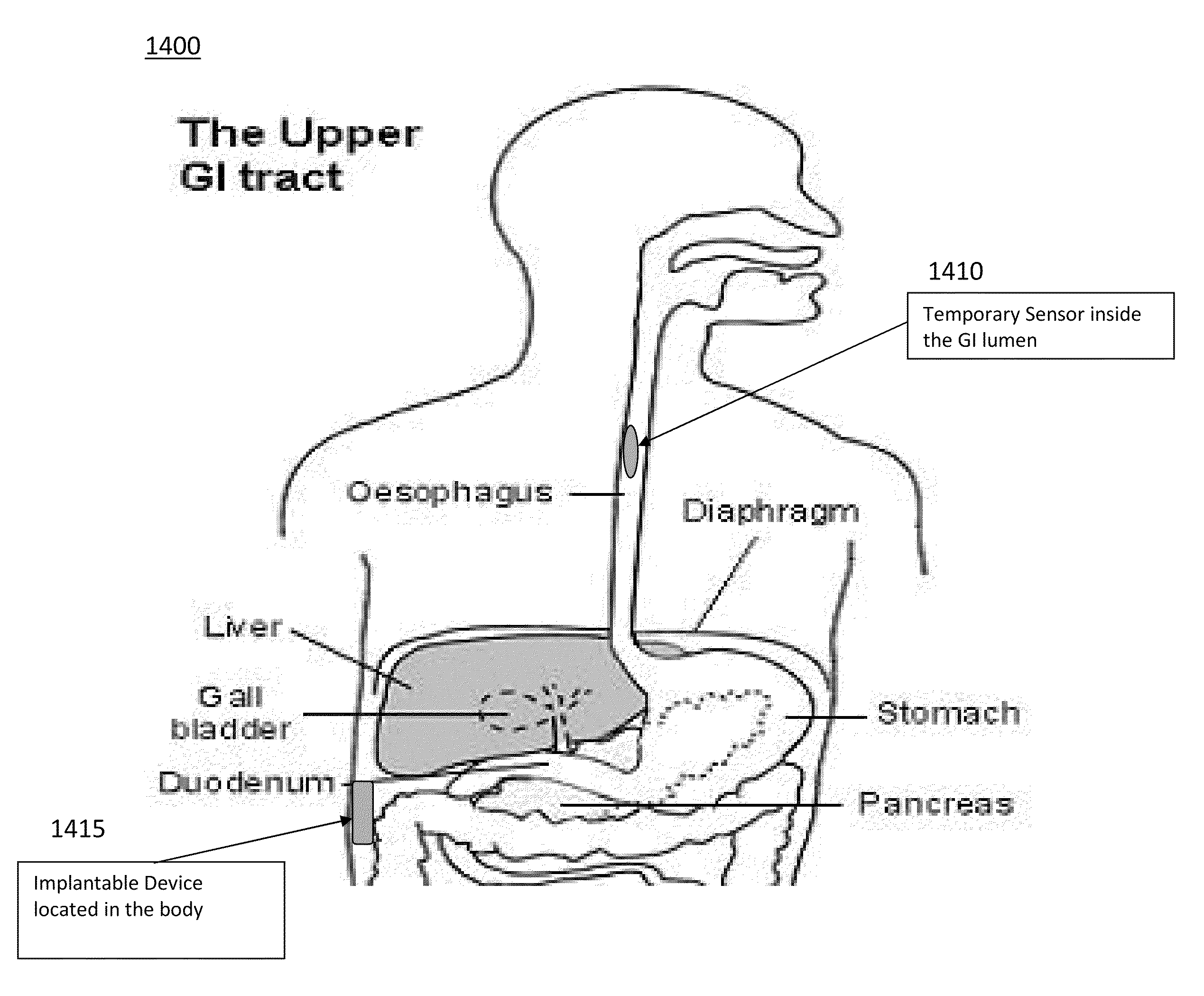 Device and implantation system for electrical stimulation of biological systems