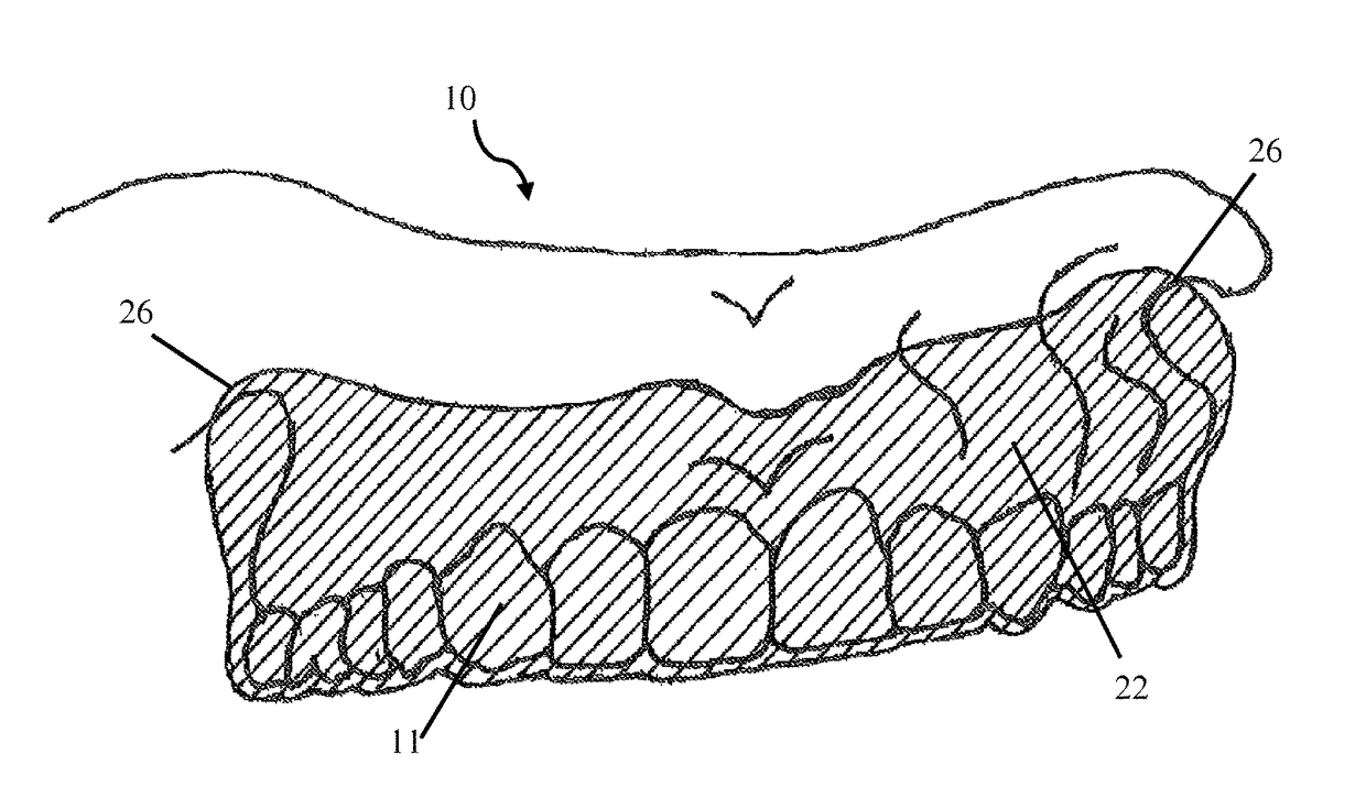 Intra-oral appliance and methods of using same