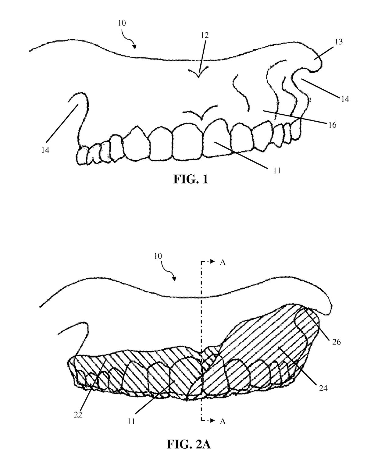 Intra-oral appliance and methods of using same