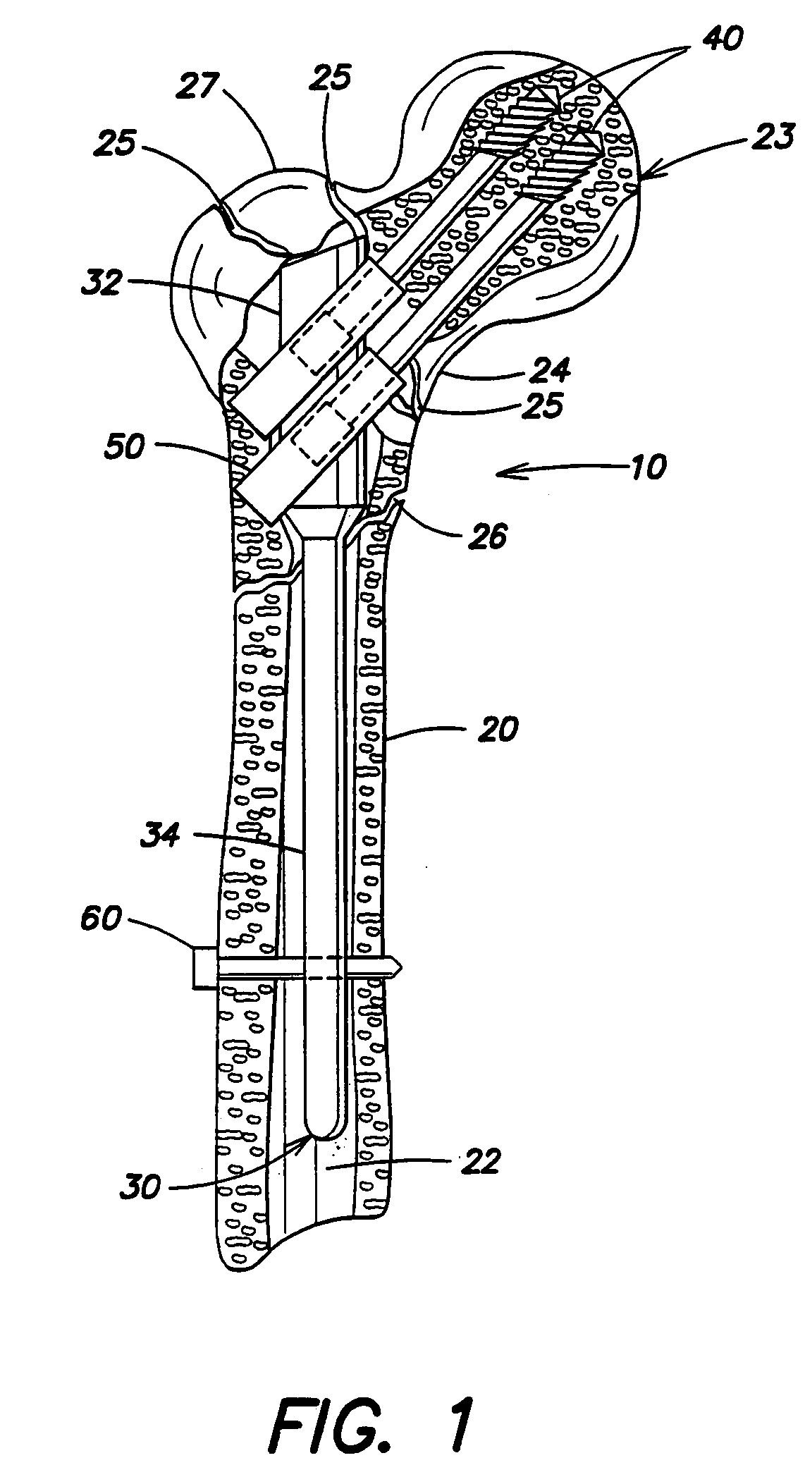 Intramedullary nail system and method for fixation of a fractured bone