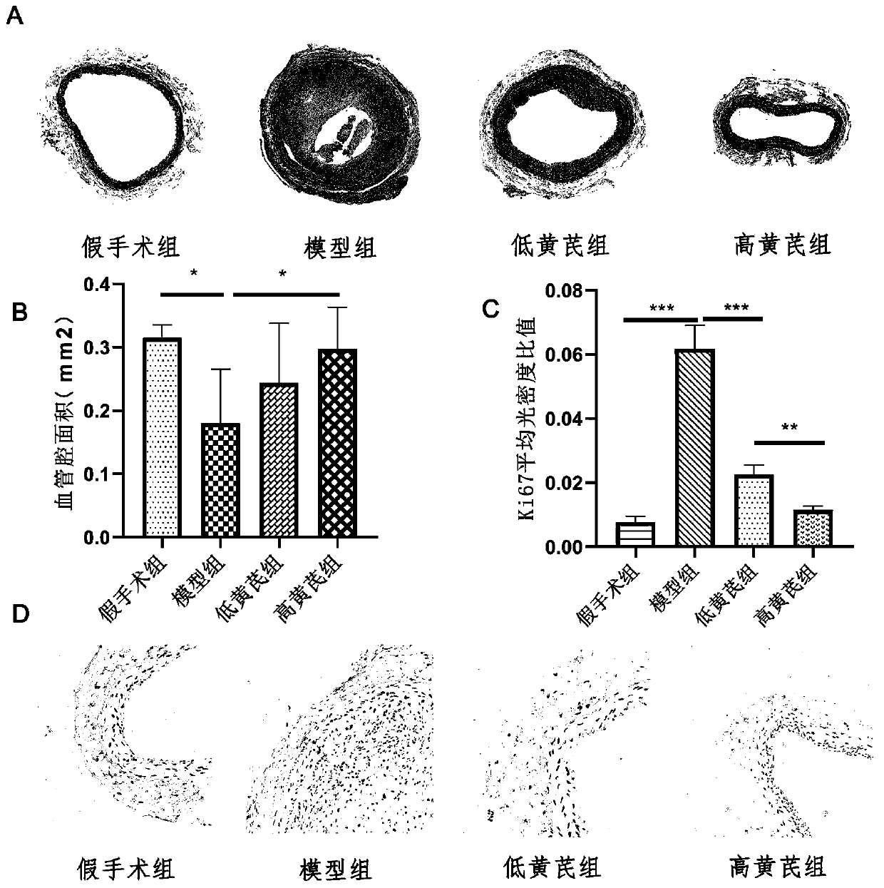 Application of astragaloside IV in inhibiting local inflammatory response and treating arterial restenosis