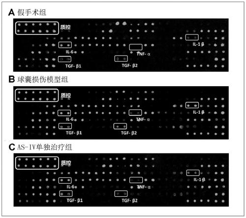 Application of astragaloside IV in inhibiting local inflammatory response and treating arterial restenosis