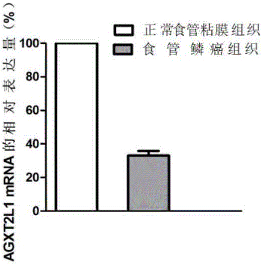 Molecular target of esophageal squamous carcinoma