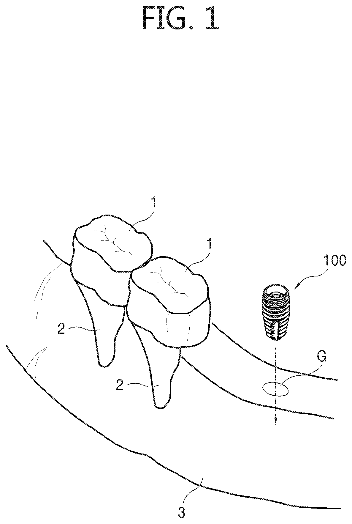 Surgical connector for dental fixture