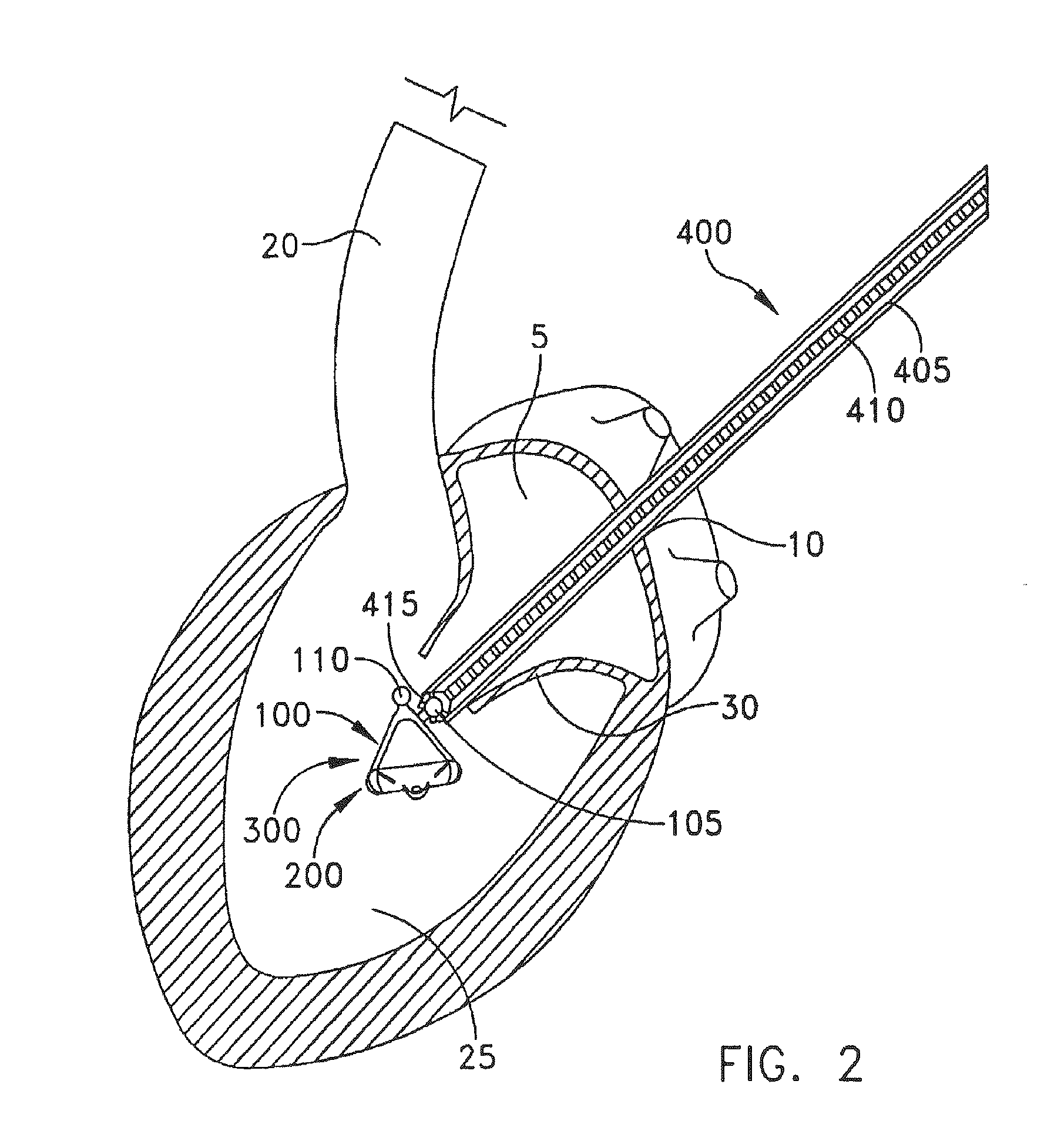 Method For Replacing Native Valve Function Of A Diseased Aortic Valve