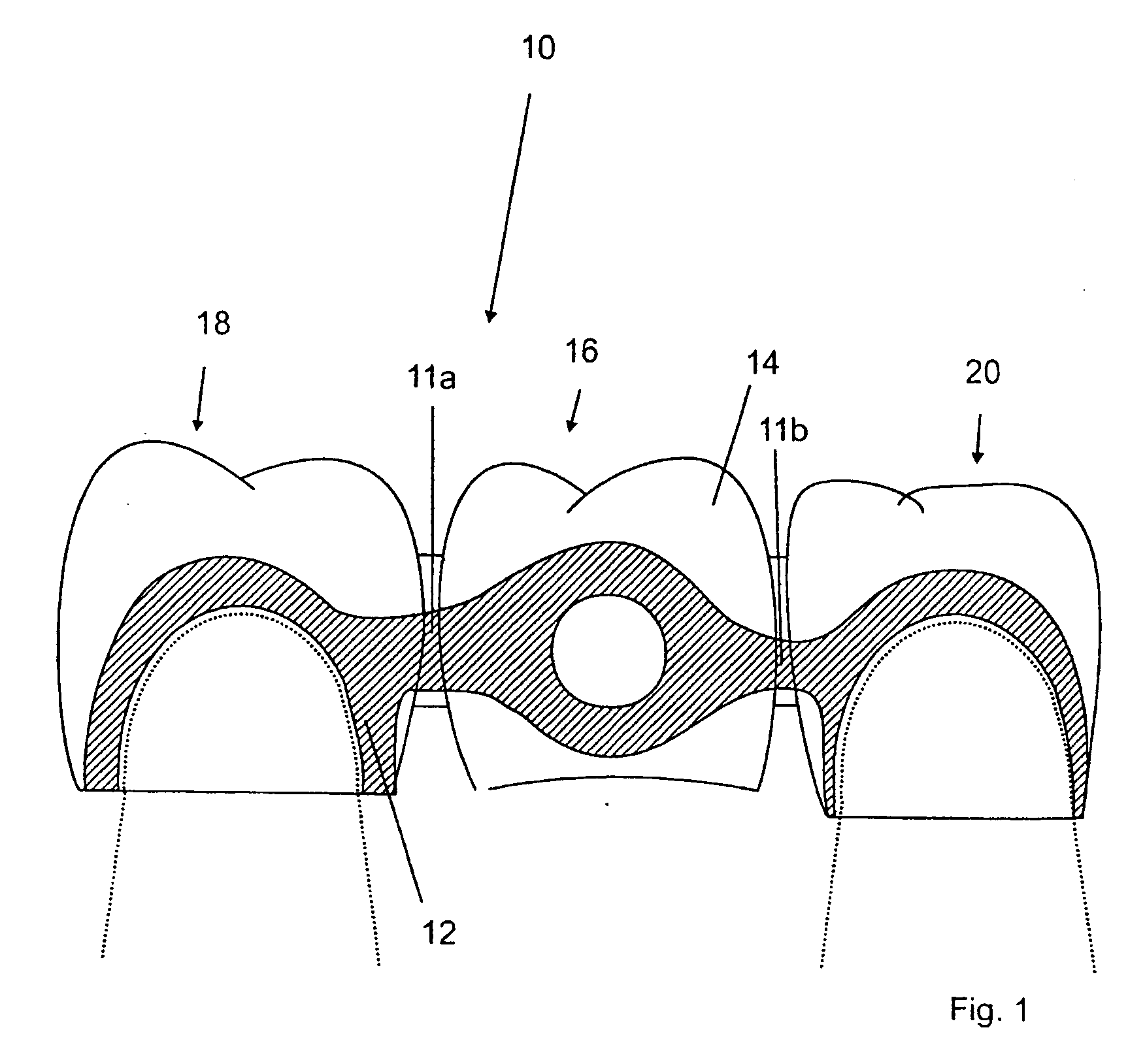 Process for the production of a dental model, a dental model with a ceramic layer deposited thereon and a dental moulding, dental model,,and use of 3D printer and a kit