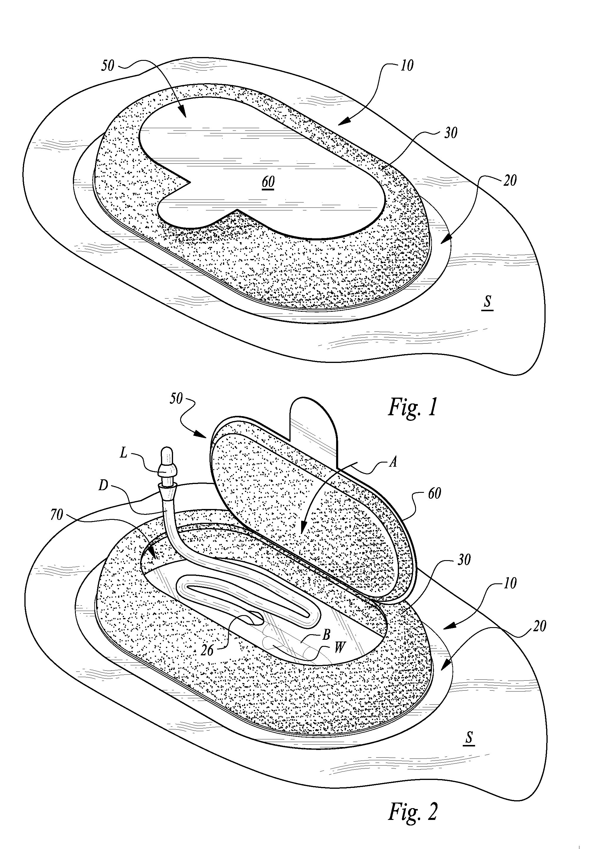 Adhesive dressing with resealable cover