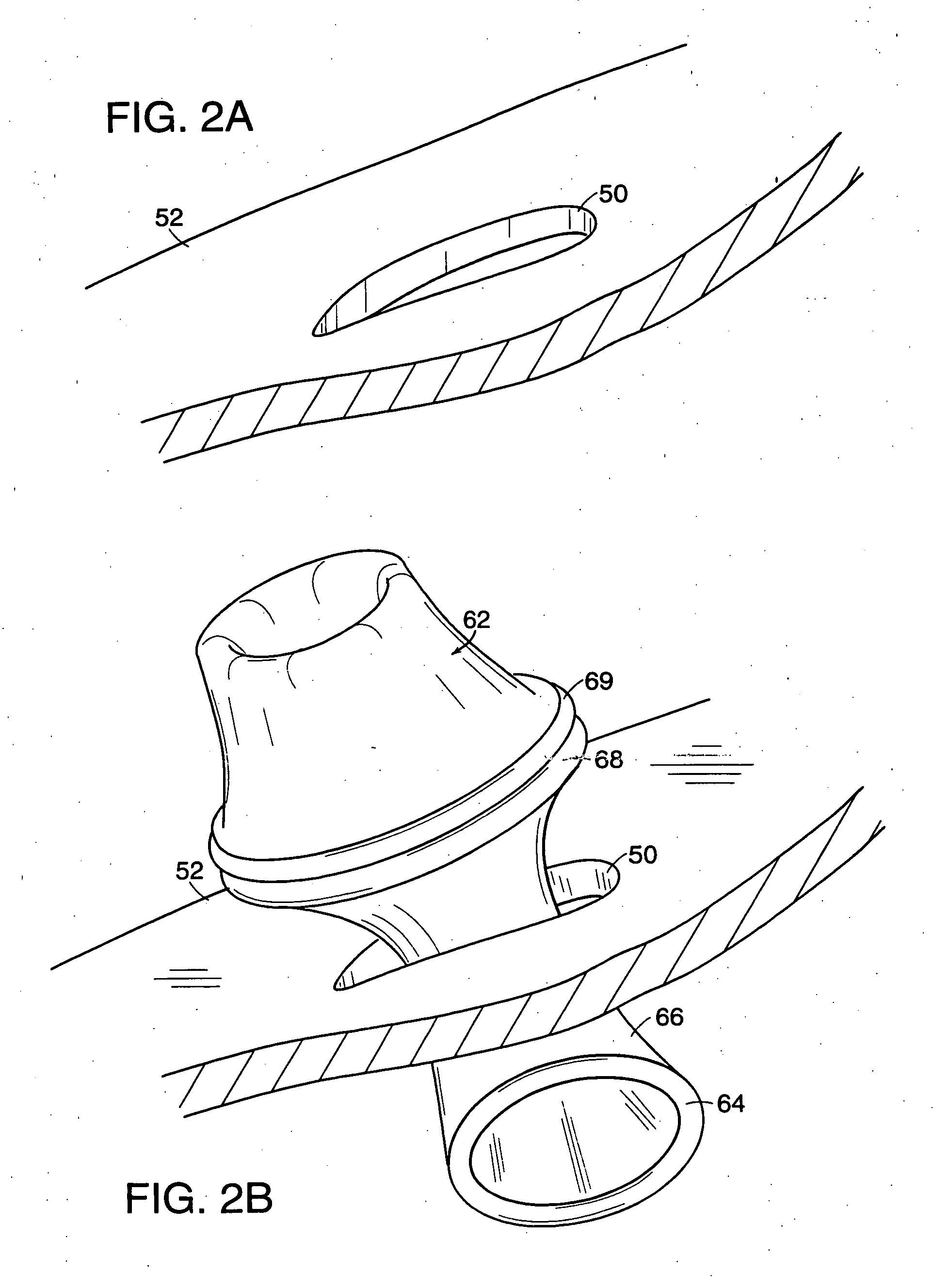 Surgical access port