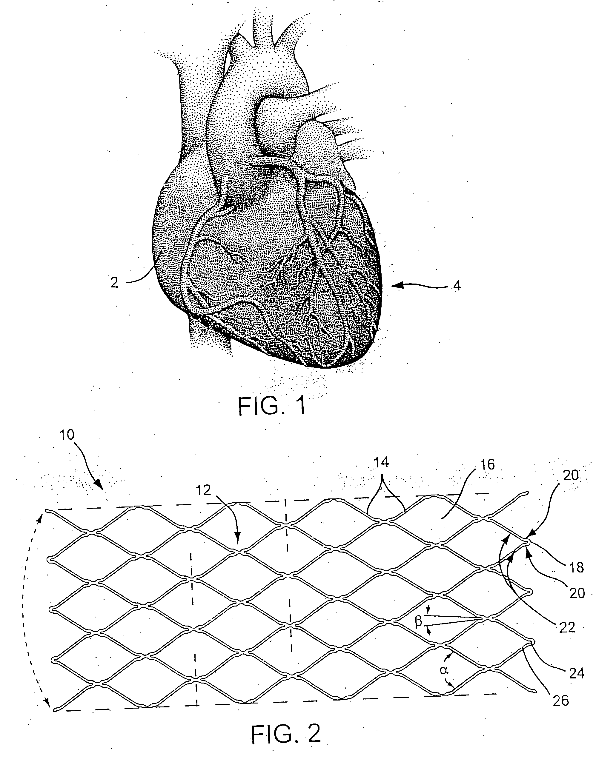 Stent delivery system with diameter adaptive restraint