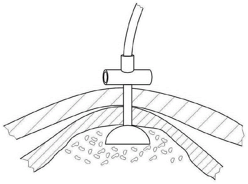 Devices and methods for percutaneous endoscopic gastrostomy and other ostomy procedures