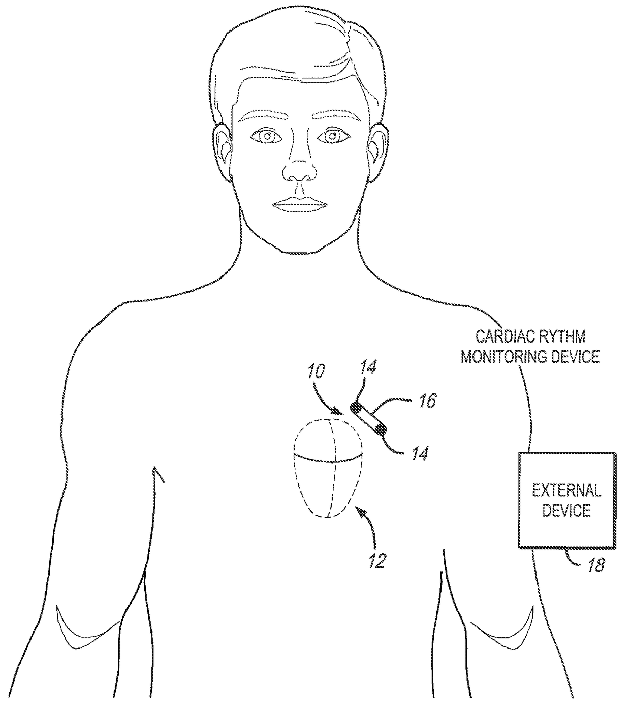 Method and system to discriminate rhythm patterns in cardiac activity