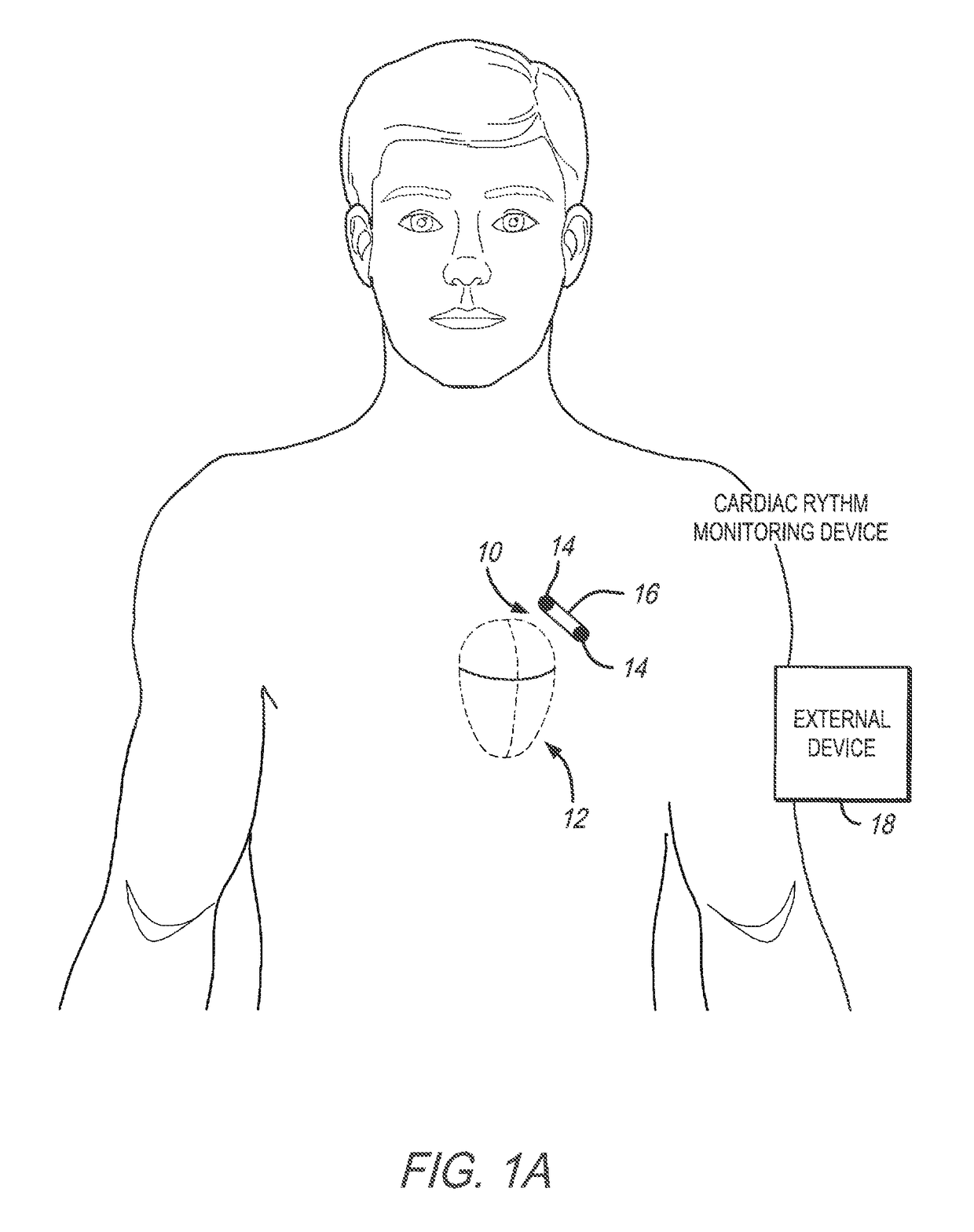 Method and system to discriminate rhythm patterns in cardiac activity