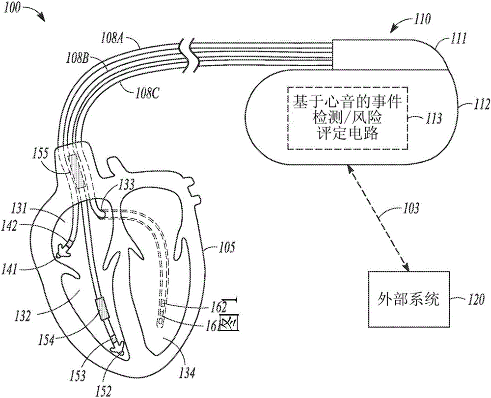 Heart failure detection and risk stratification system