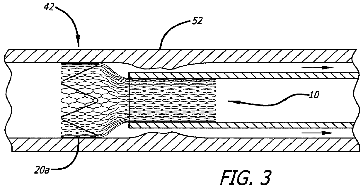 Braided stent with expansion ring and method of delivery