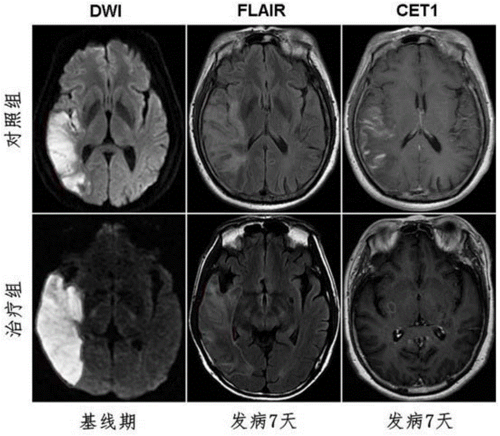 Application of fingolimod and analogue thereof in preparing medicines for treating cerebral infarction