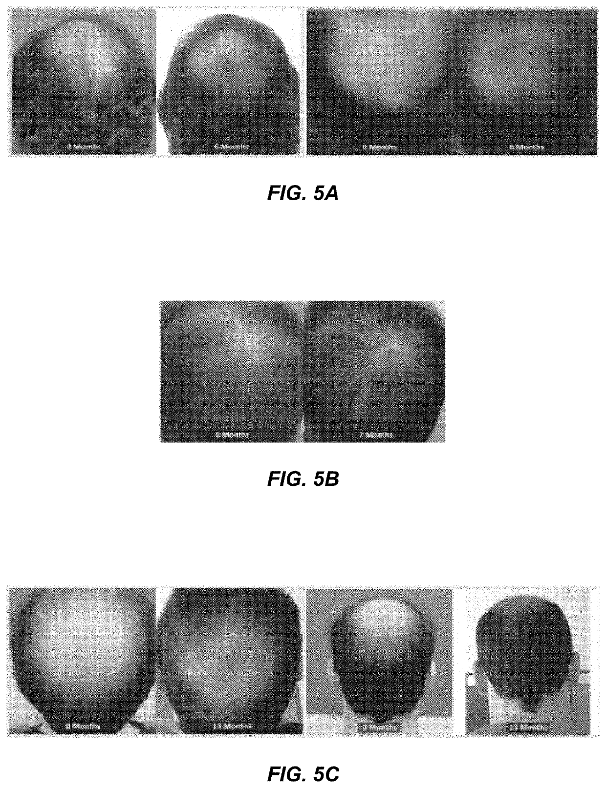 Topical formulations for treating dermatological disorders including male pattern baldness