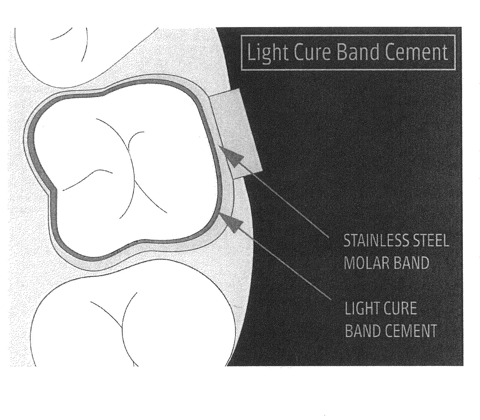 Anti-microbial orthodontic compositions and appliances and methods of production and use thereof