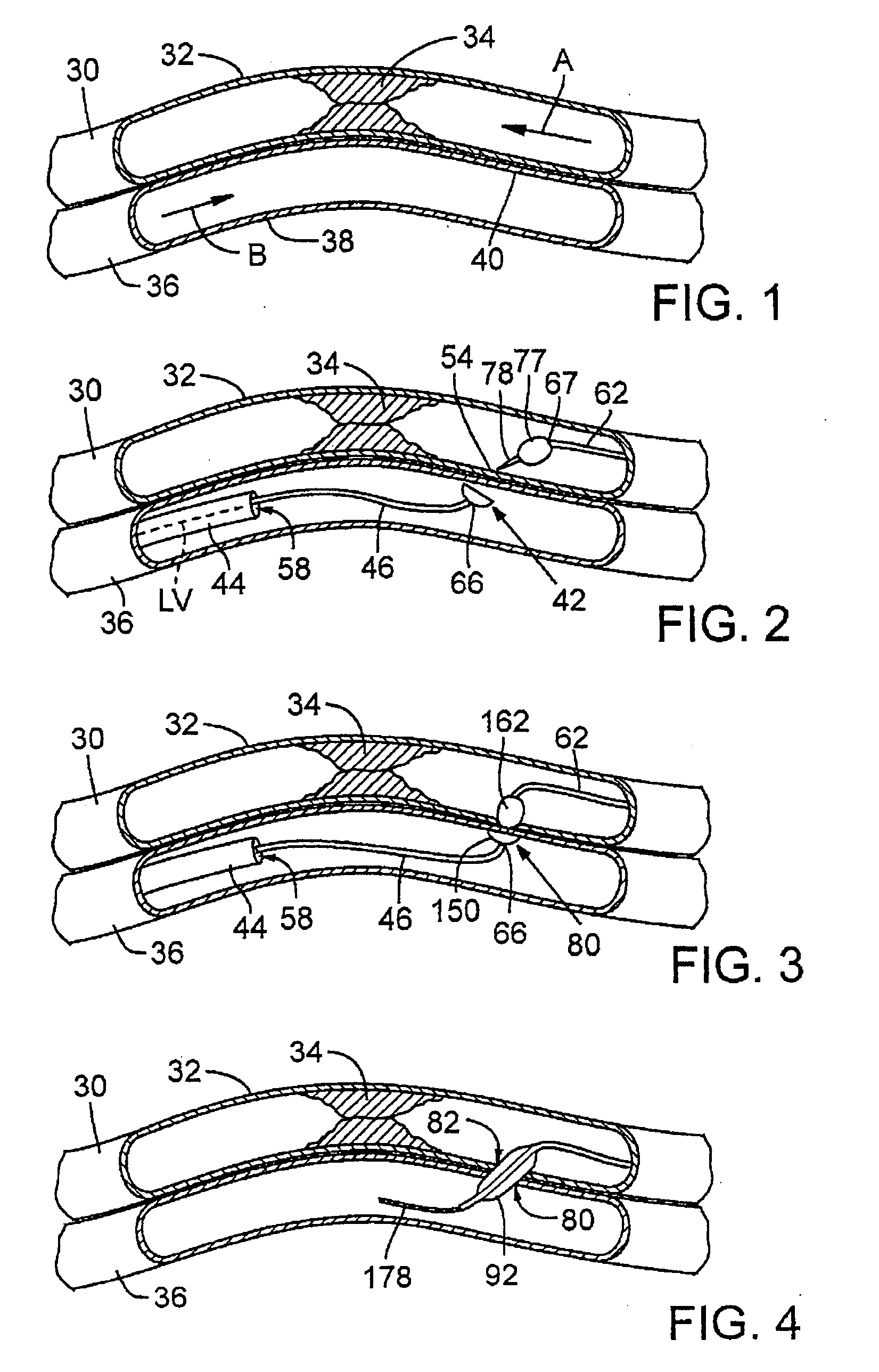 Catheter system for connecting adjacent blood vessels