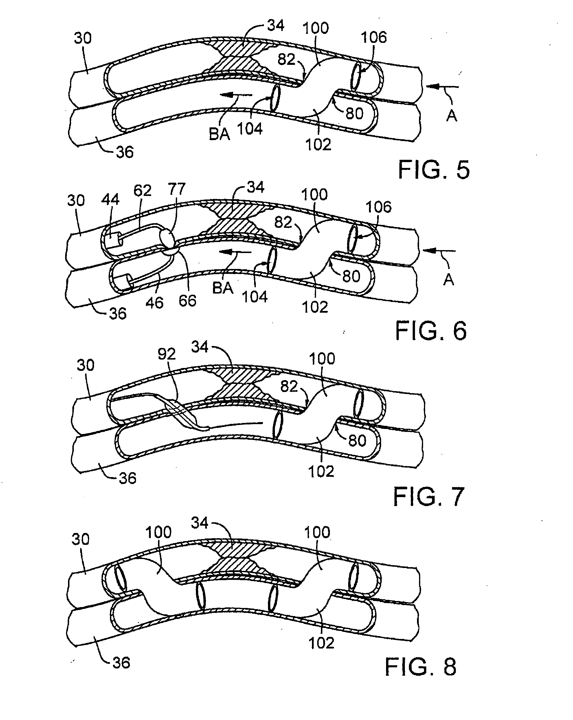 Catheter system for connecting adjacent blood vessels