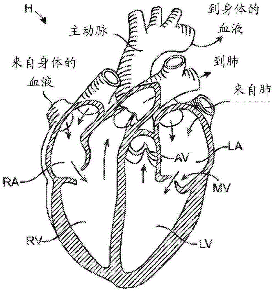 Implantable heart valve devices, mitral valve repair devices and associated systems and methods