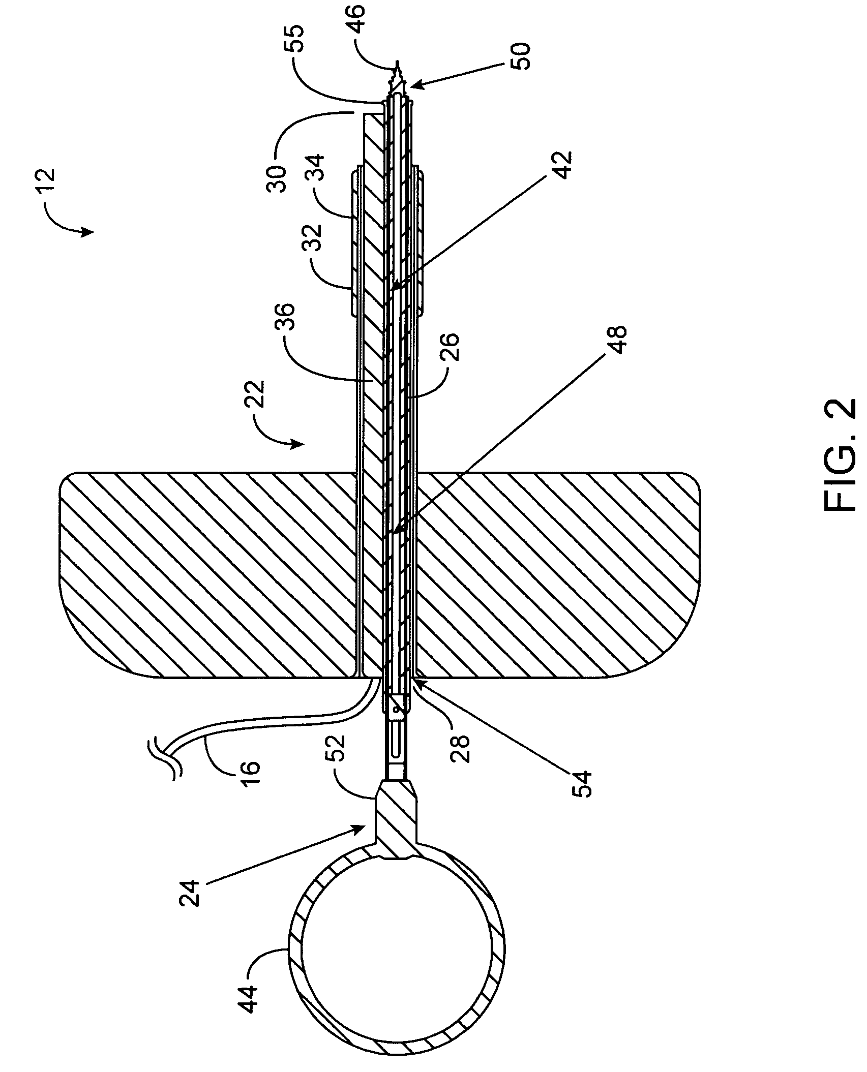 Mechanically registered videoscopic myringotomy/tympanostomy tube placement system