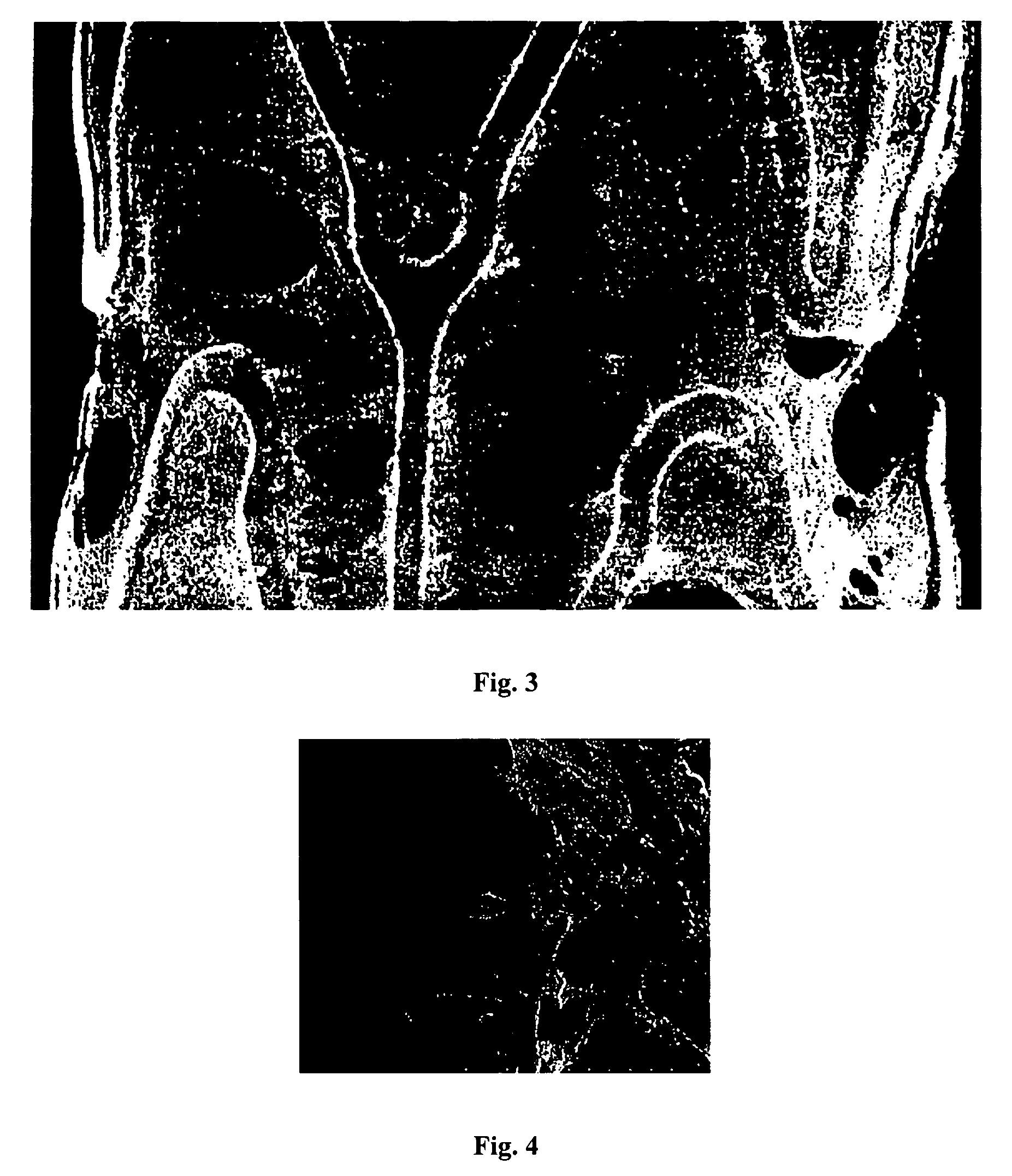 Encapsulated covered stent