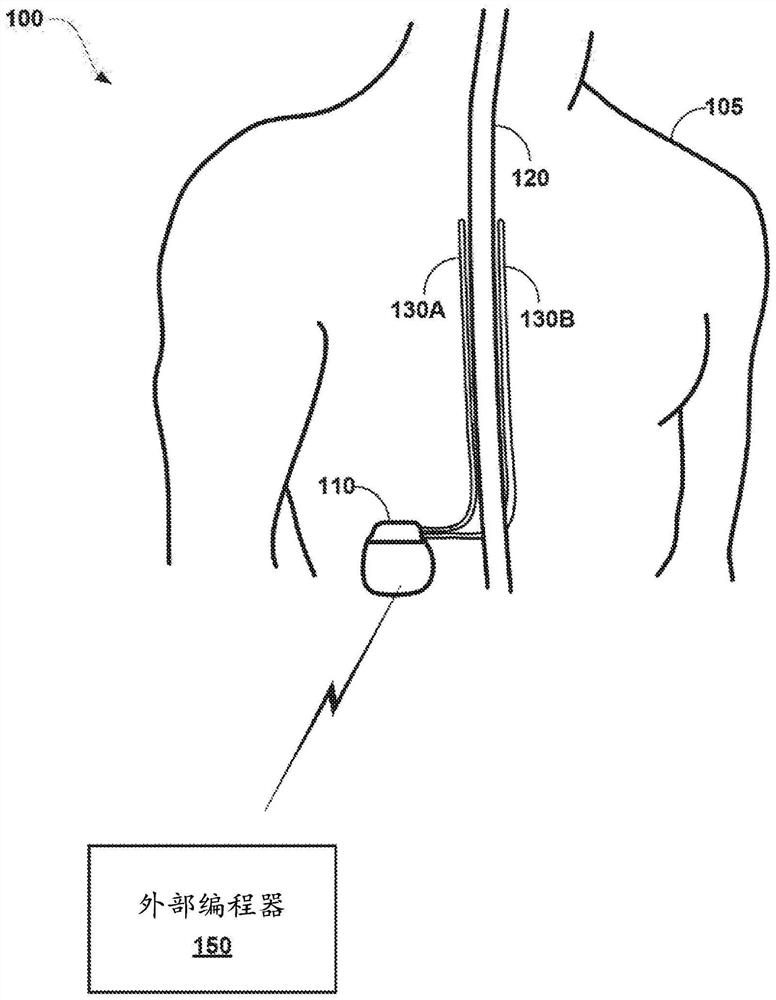 ECAP-based transient overstimulation