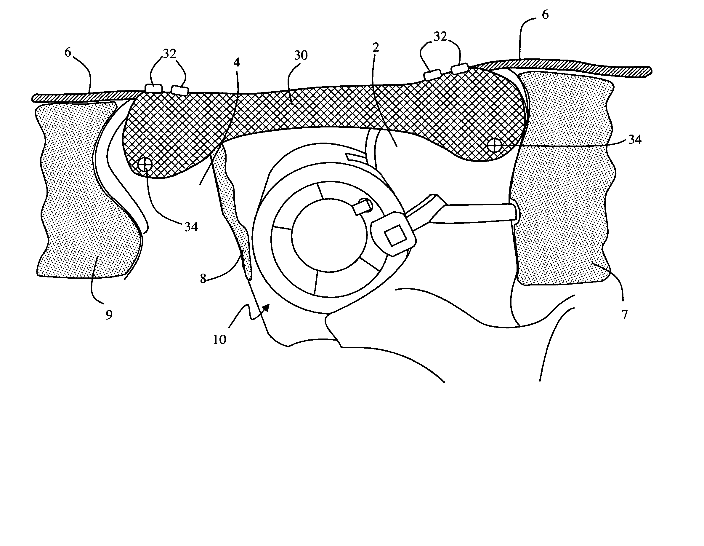 Methods and apparatus for treating spinal stenosis