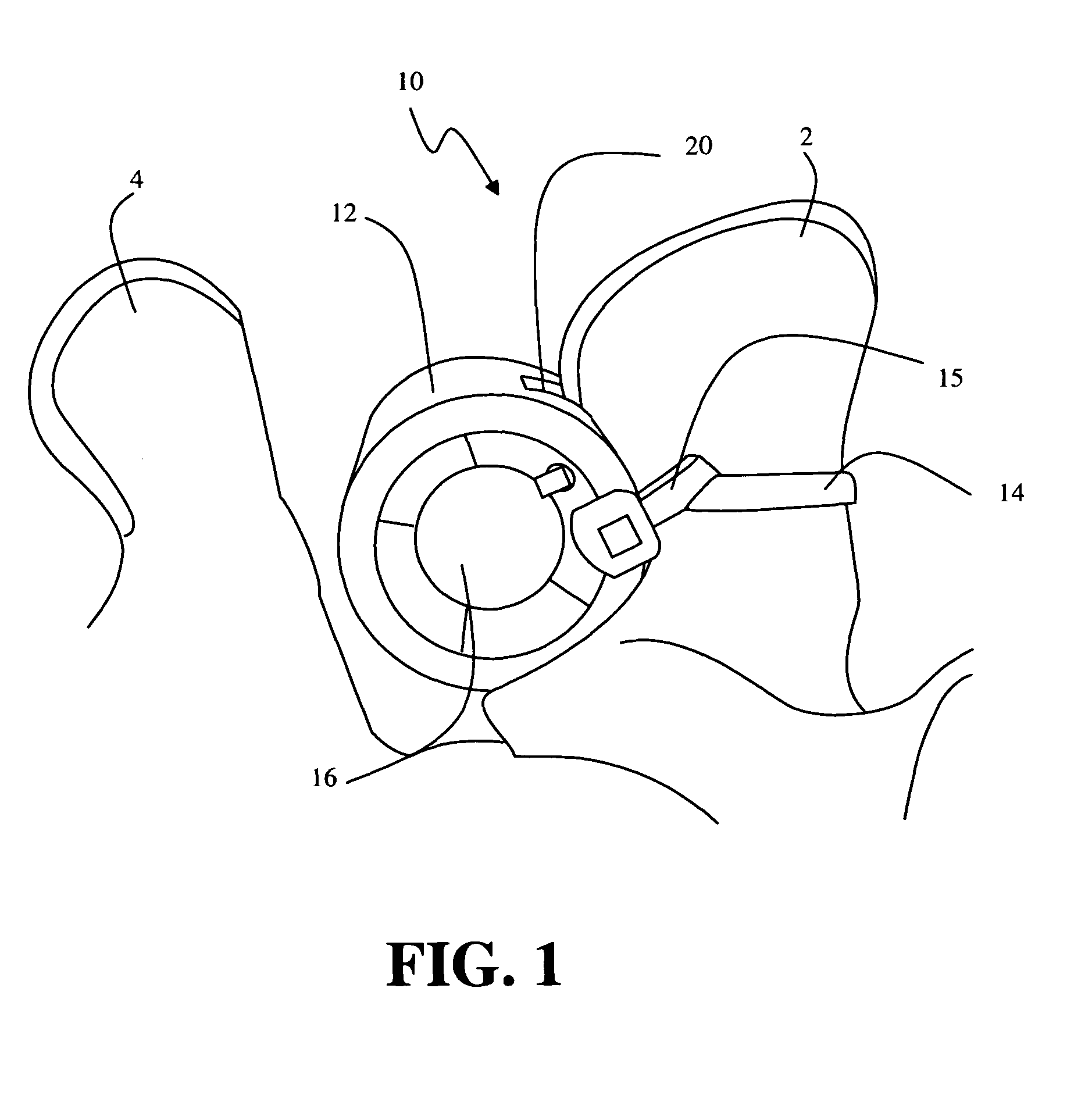 Methods and apparatus for treating spinal stenosis