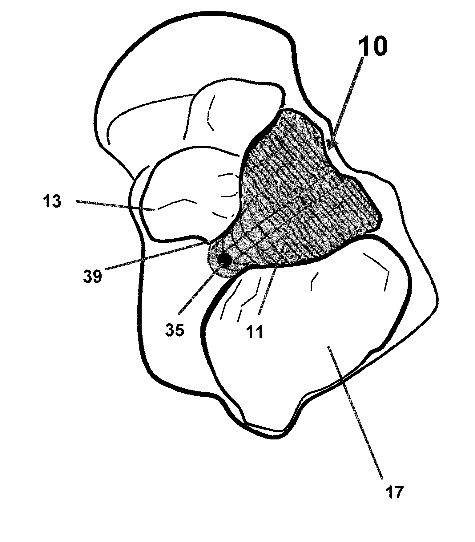 Subtalar arthroereisis implant apparatus and treatment method