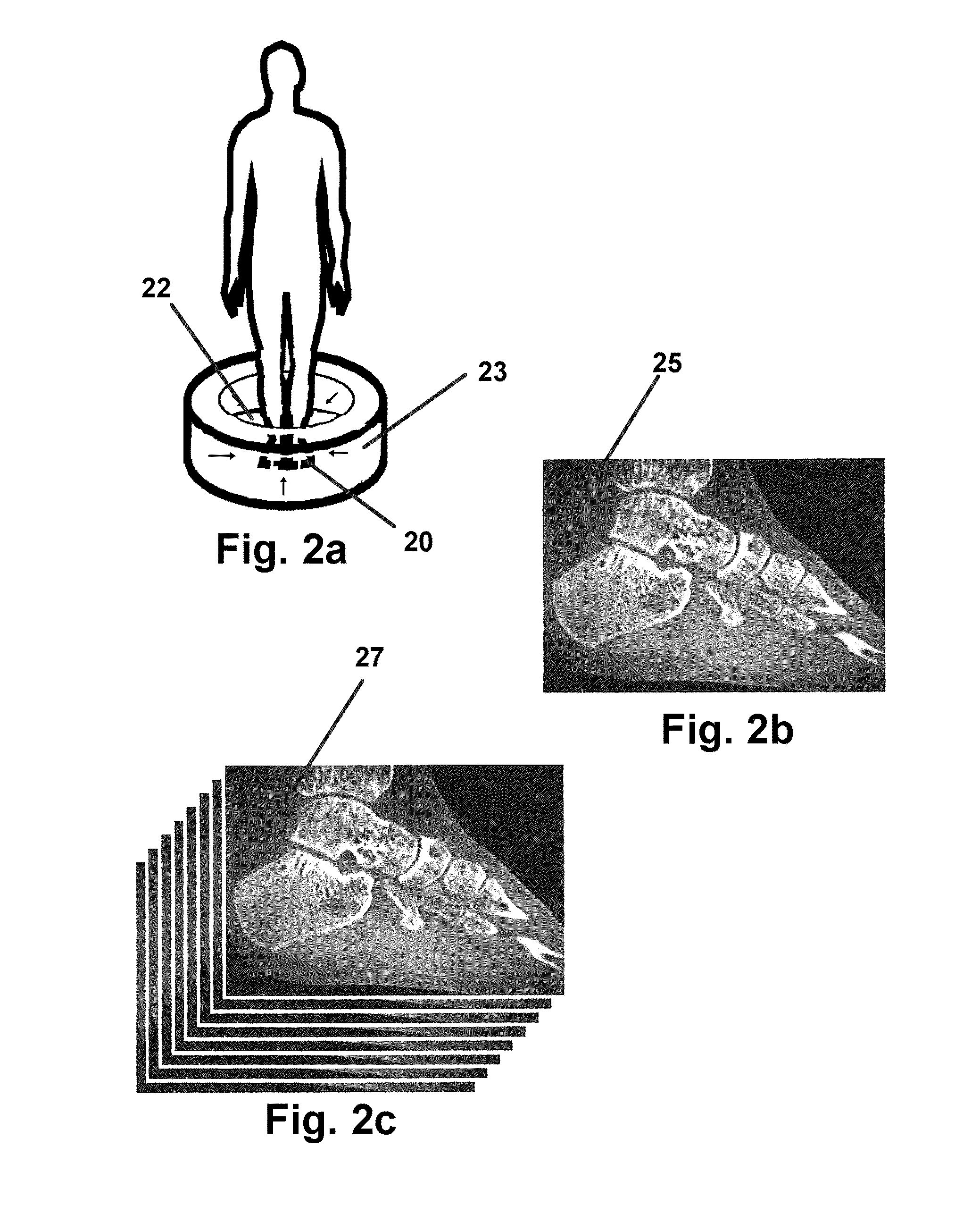 Subtalar arthroereisis implant apparatus and treatment method