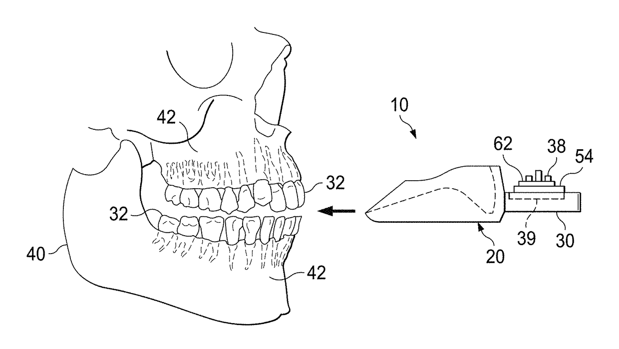 Orthodontic accelerator